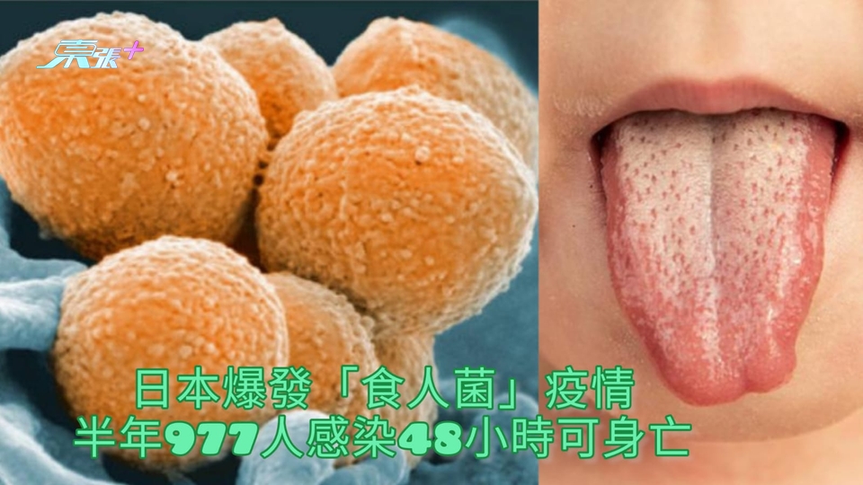 日本爆發「食人菌」疫情 半年977人感染48小時可身亡