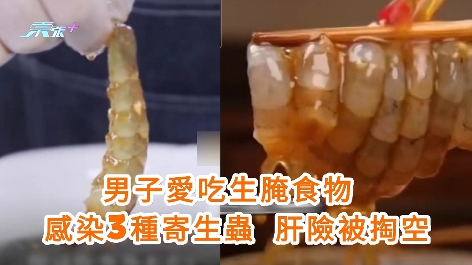 男子愛吃生腌食物 感染3種寄生蟲 肝險被掏空