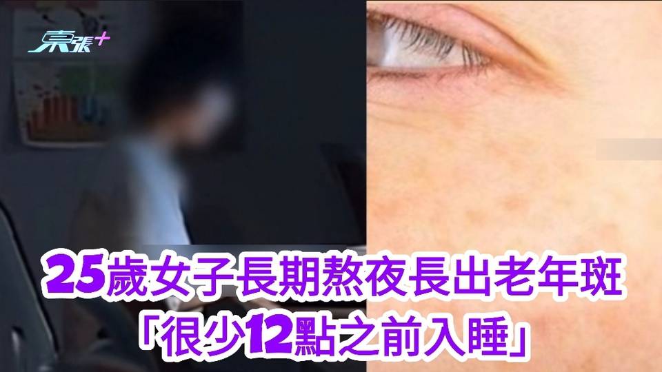 有片 | 25歲女子長期熬夜長出老年斑 「很少12點之前入睡」 網民：「我一直在熬夜怎麽辦」