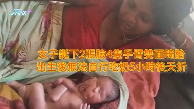 女子誕下2張臉4隻手臂雙面畸胎 出生後無法自行吃奶5小時後夭折